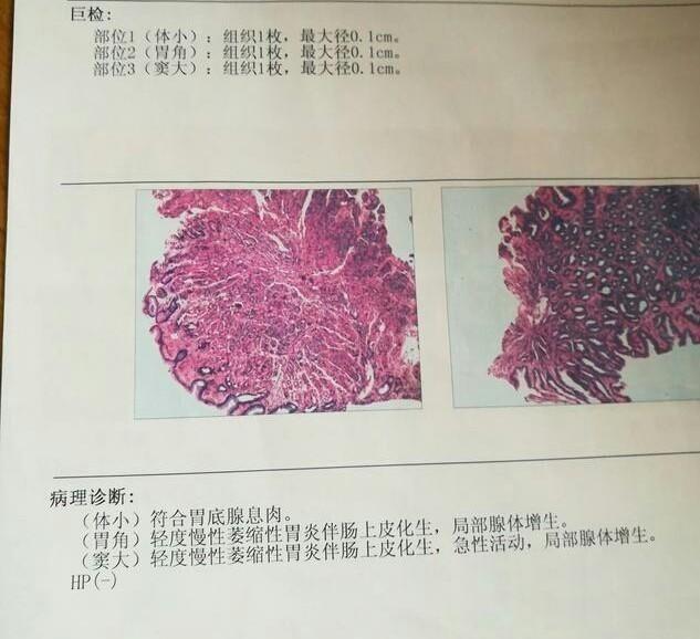 肠化十号是什么意思？